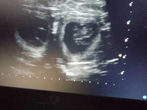 Erstes Ultraschall